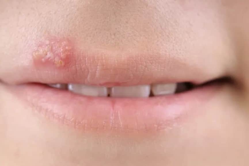 Imagen de herpes labial activo con pequeña ampolla sobre el labio superior causada por el virus del herpes simple.