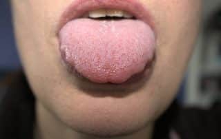 Inflamación de la lengua mostrando enrojecimiento y hinchazón