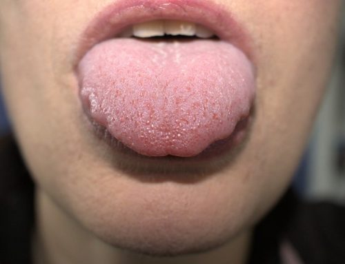 Inflamación Lengua: Guía de Prevención, Síntomas y Tratamientos