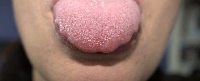 Inflamación de la lengua mostrando enrojecimiento y hinchazón