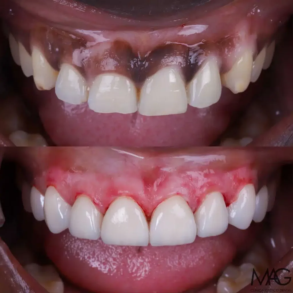 tratamiento peeling encías negras antes y después