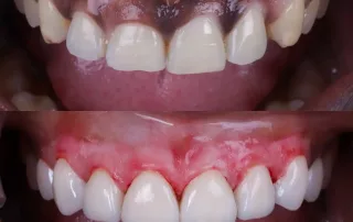 tratamiento peeling encías negras antes y después