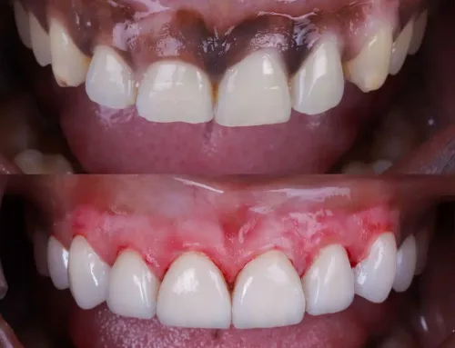 Encías negras: causas, tratamiento y cómo aclararlas 