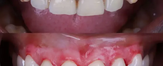 tratamiento peeling encías negras antes y después