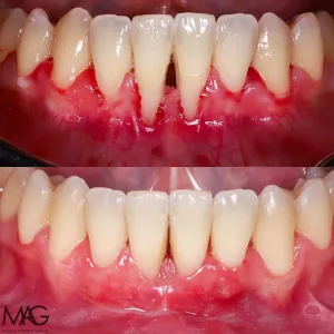 caso de injerto de encía antes y después