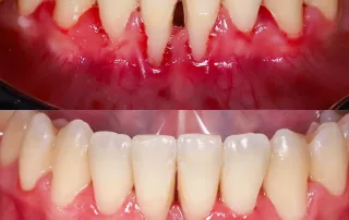 caso de injerto de encía antes y después
