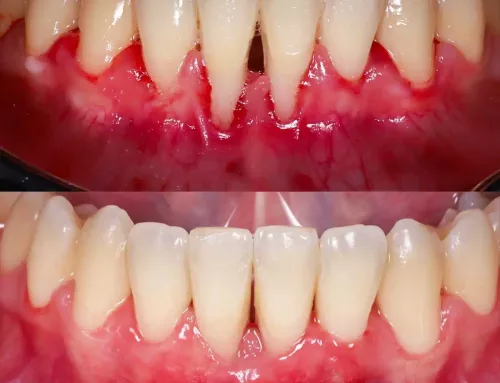 Injerto de encía: precio, recuperación y evolución paso a paso