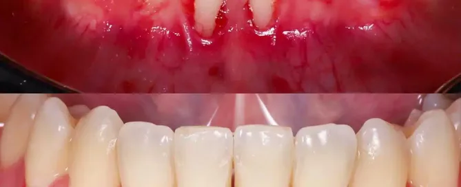 caso de injerto de encía antes y después