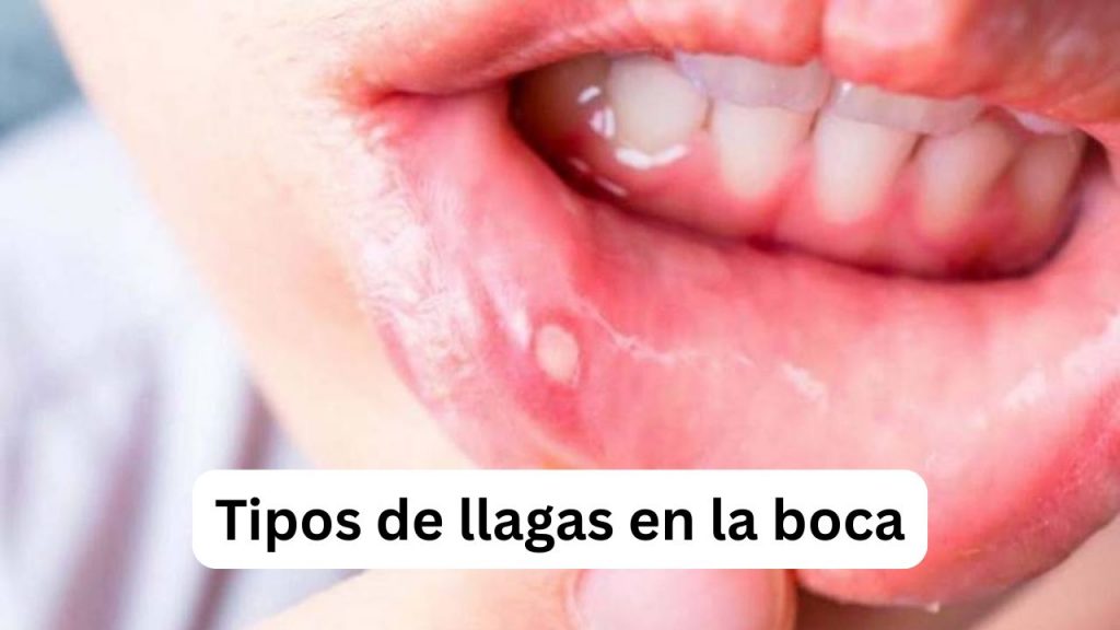 Tipos de llagas en la boca: aftas menores, aftas mayores y herpes labial con ejemplos visuales