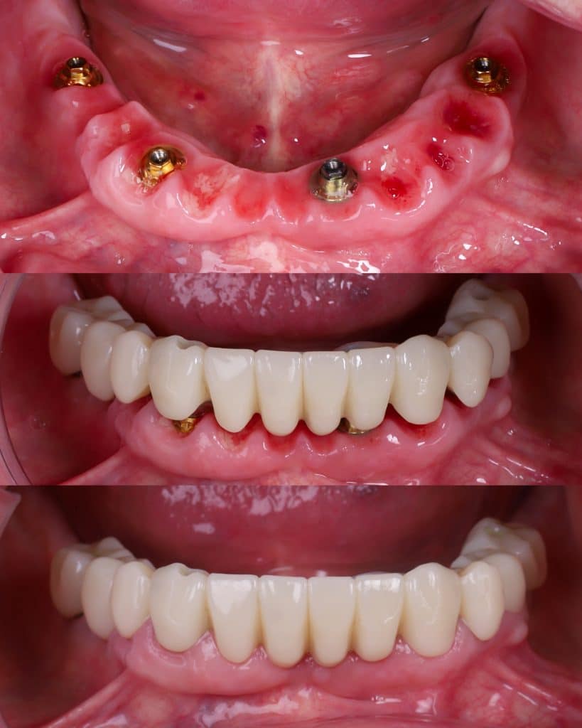 foto de implante completo para pr&oacute;tesis fija sobre 4 implantes