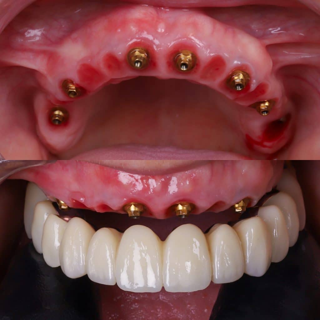 foto de implante dental completo con pr&oacute;tesis fija sobre 6 implantes de carga inmediata