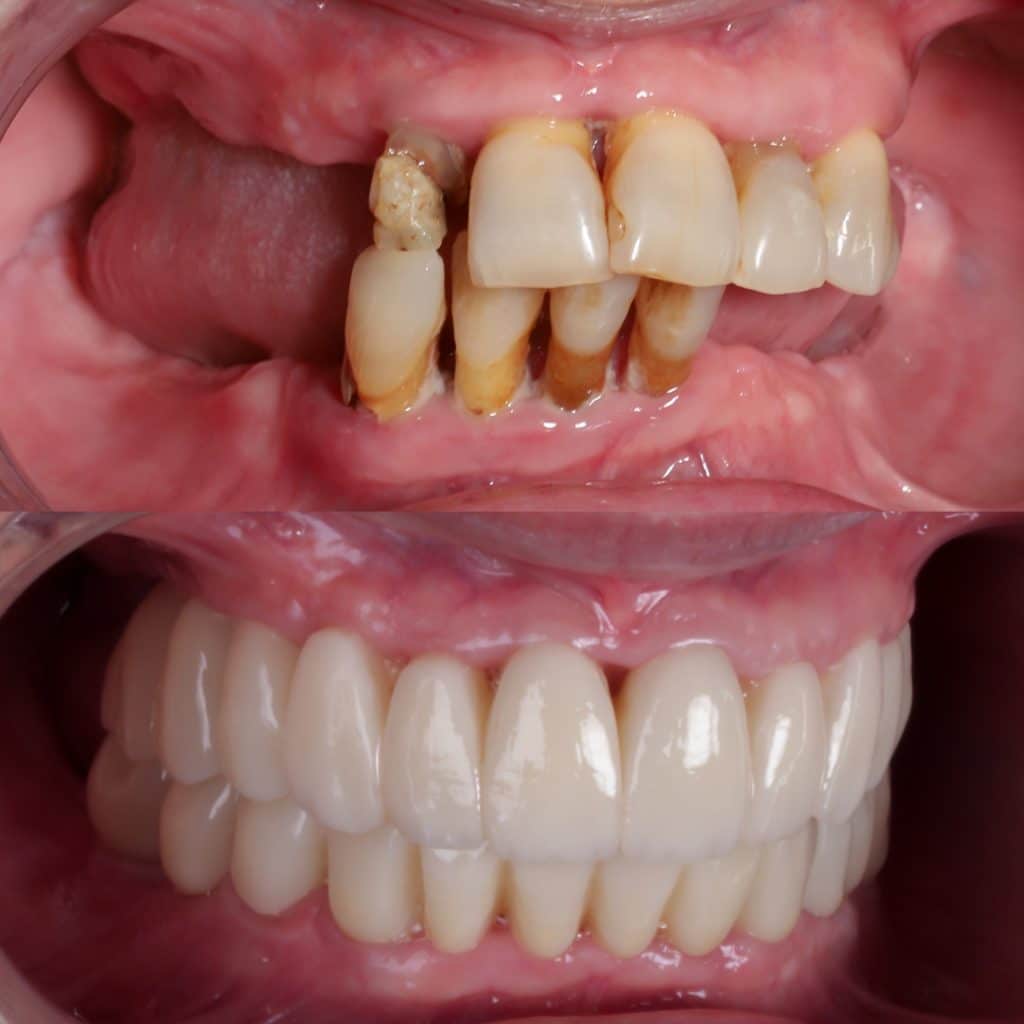 foto de implante dental completo en paciente sin hueso