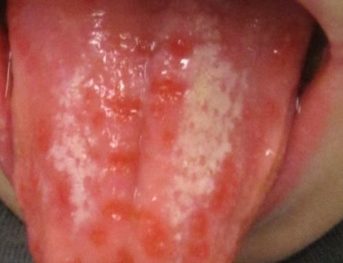 Curar llagas lengua: por qué salen y cómo tratarlas correctamente