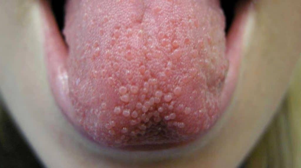 Lengua con úlcera roja e inflamada en la superficie