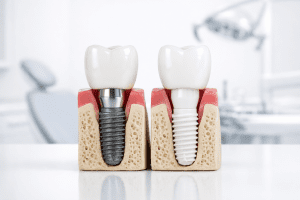 implantes dentales zirconio y titanio