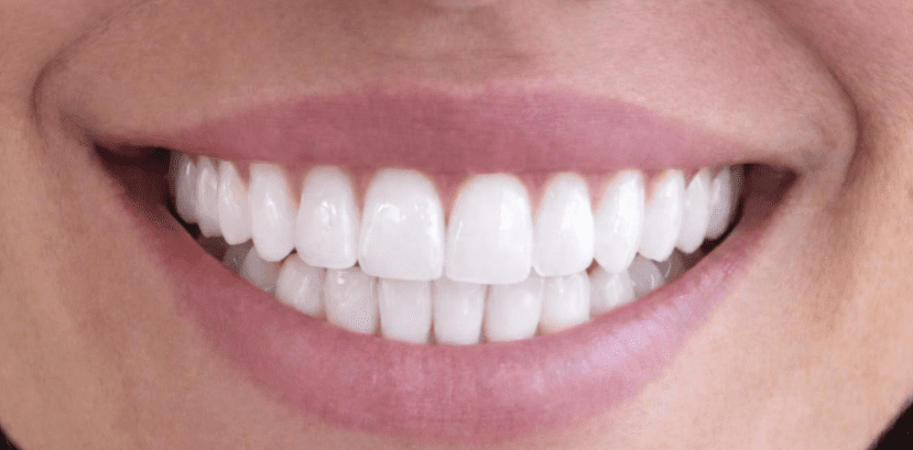 blanqueamiento dental resultados