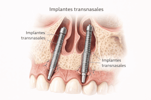 implantes transnasales procedimiento