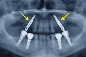 planificacion implantes transnasales