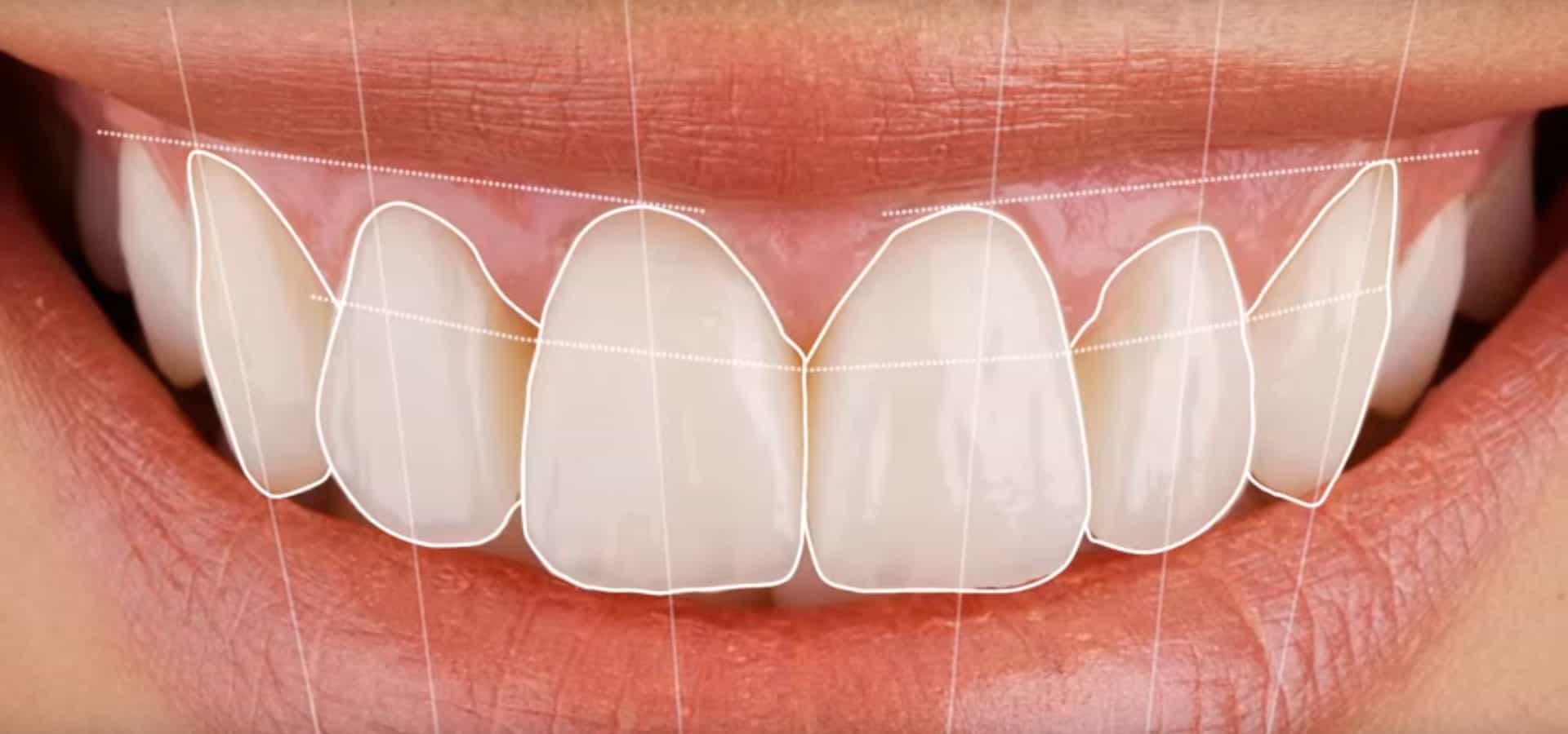 diseño digital de sonrisa