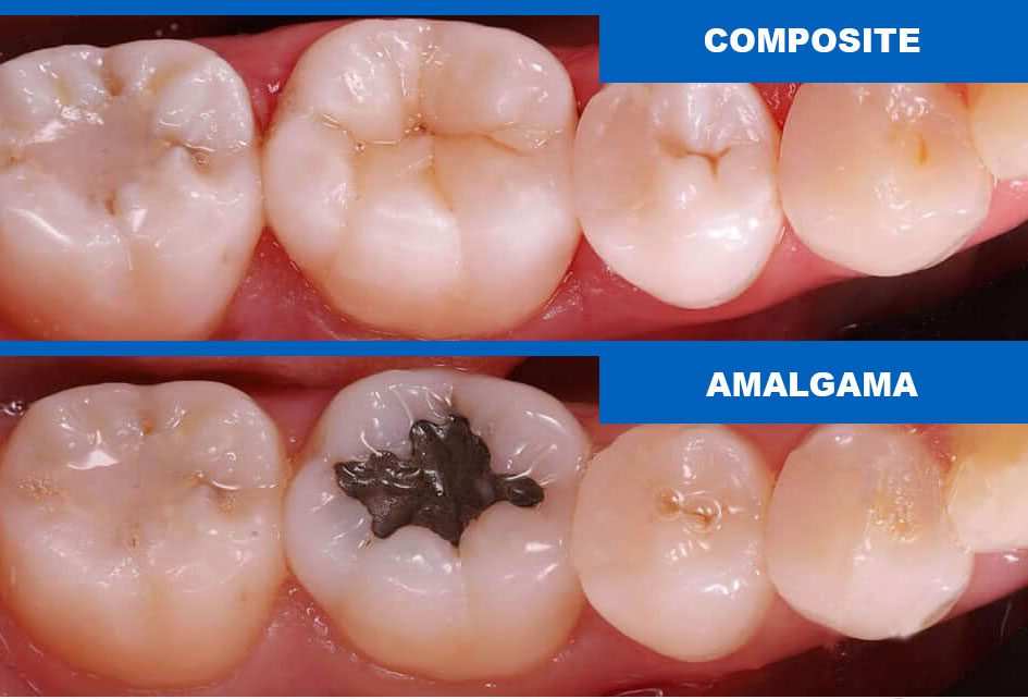 empaste dental tratamiento caries