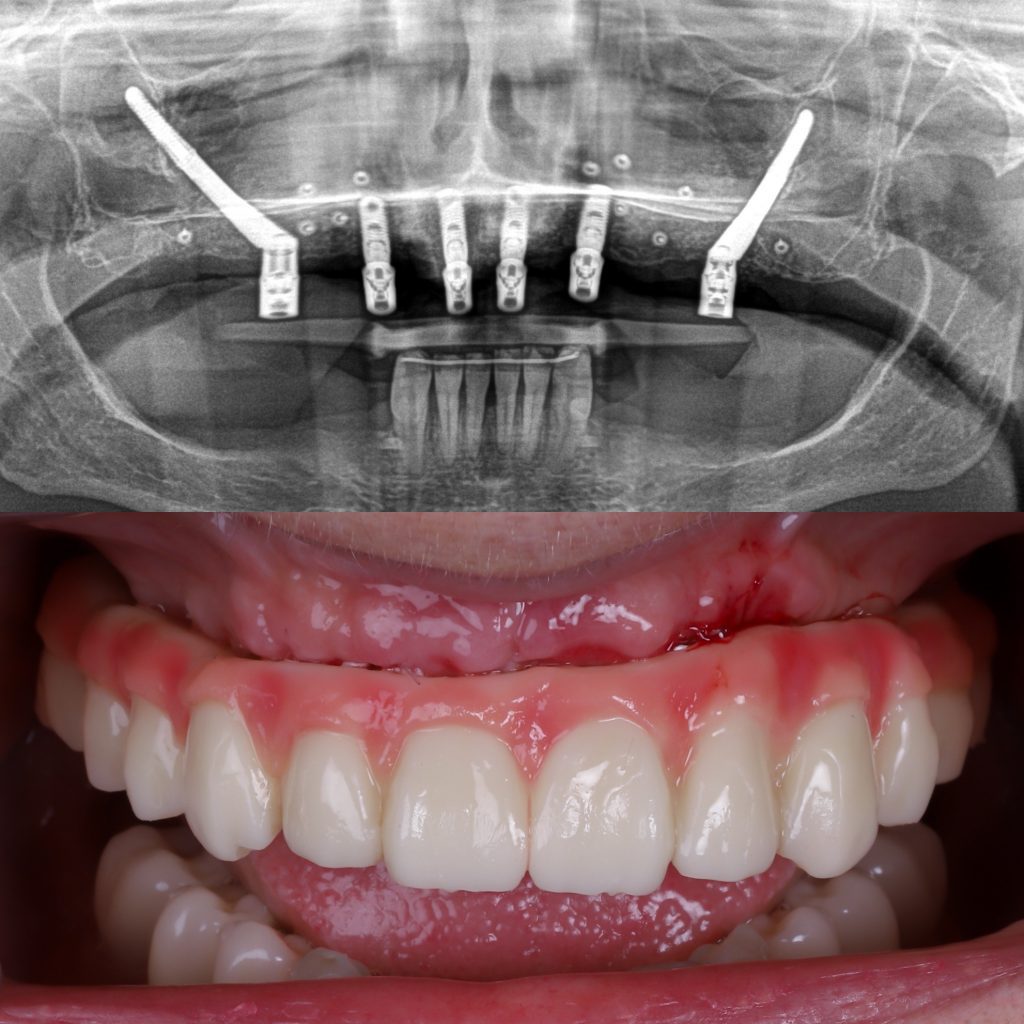 implantes dentales sin hueso
