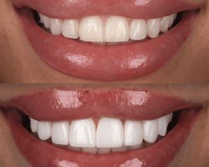 tipos de carillas dentales porcelana y composite clínica dental Madrid