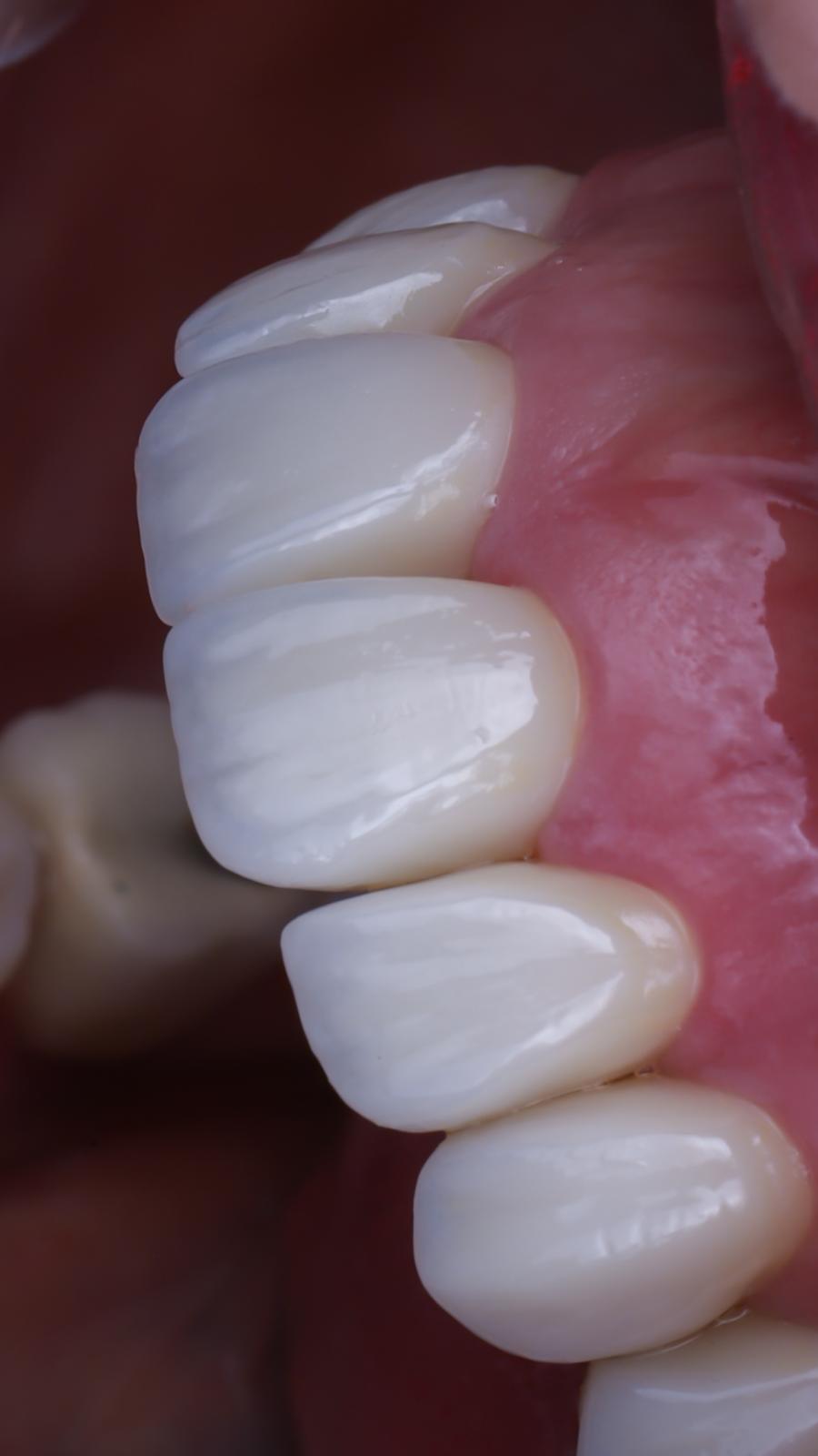 Carillas dentales en Madrid
