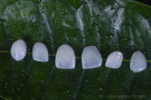 carillas dentales para dientes desalineados y sonrisas asimétricas en Madrid