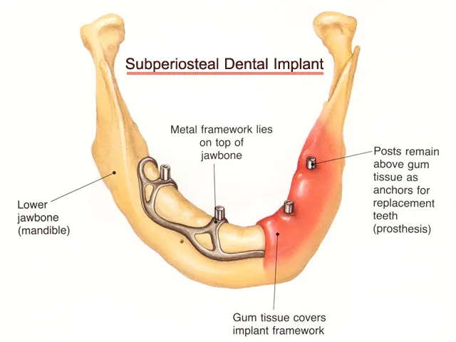 implante subperiostico estructura
