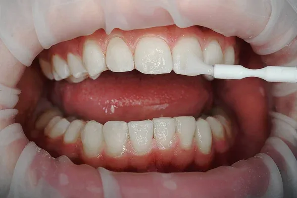 tipos de fluor tratamiento dental