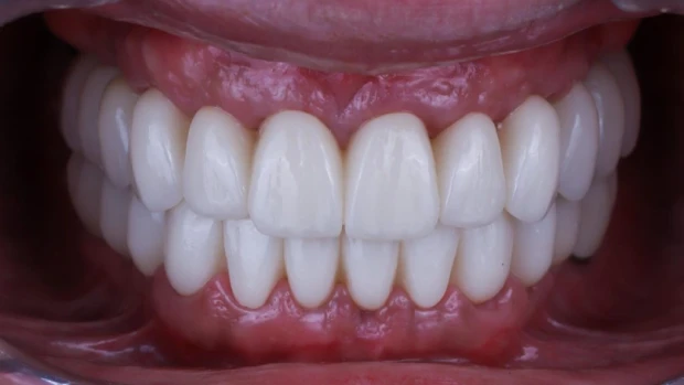 implantes carga inmediata tratamiento