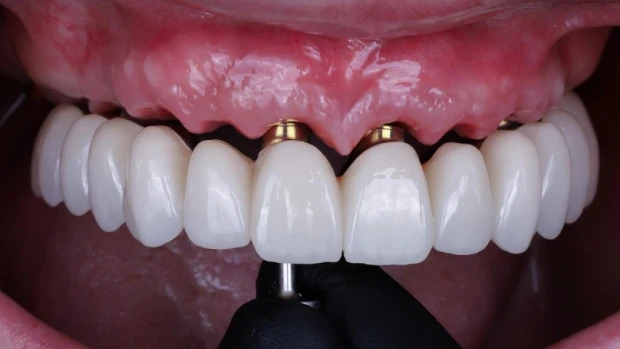 procedimiento carga inmediata implantes