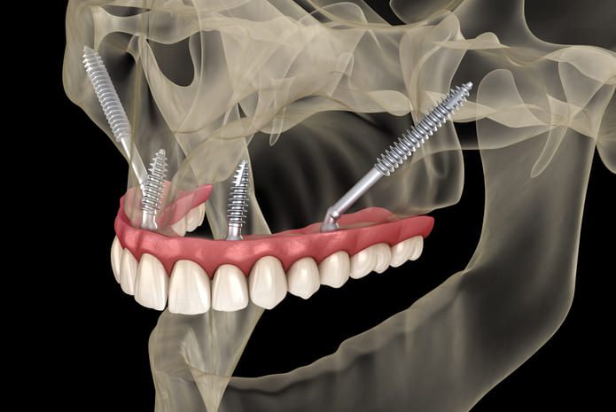 caso clinico implantes dentales