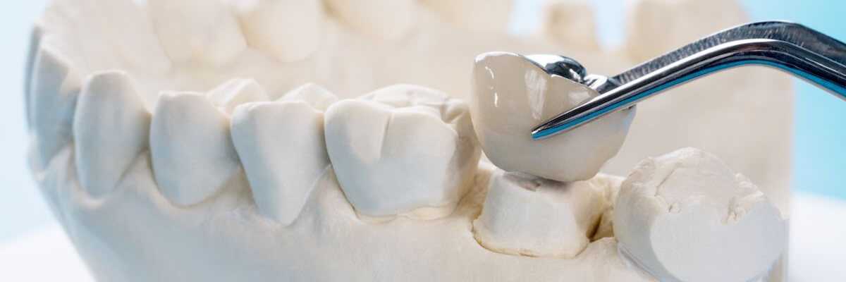 corona dental fija