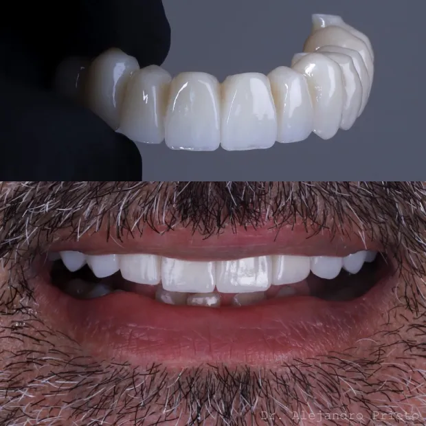 dentadura fija sobre implantes