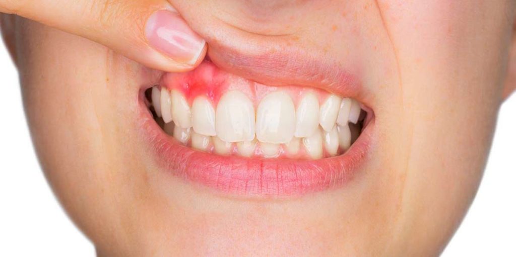 gingivitis inflamacion encías