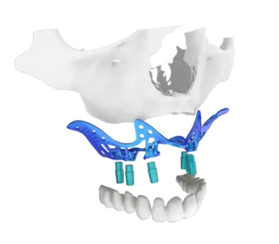 implantes subperiosticos sin tornillos