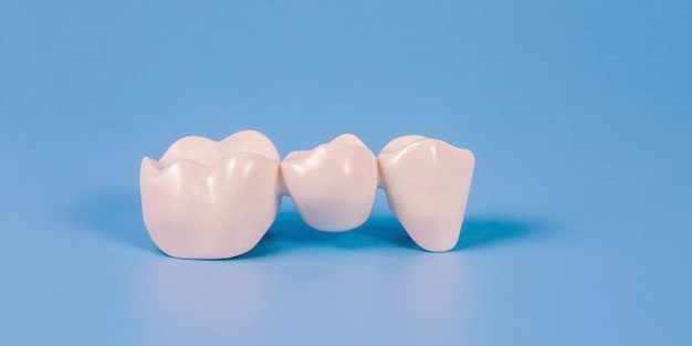 puente dental tratamiento