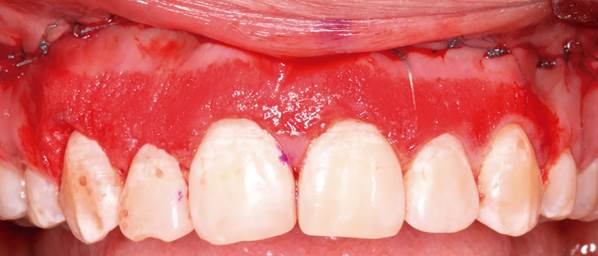 procedimiento reposicionamiento labial