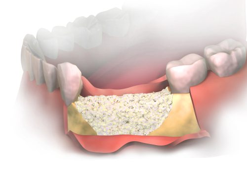 injerto de hueso dental procedimiento