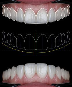 carillas de porcelana sonrisa estetica