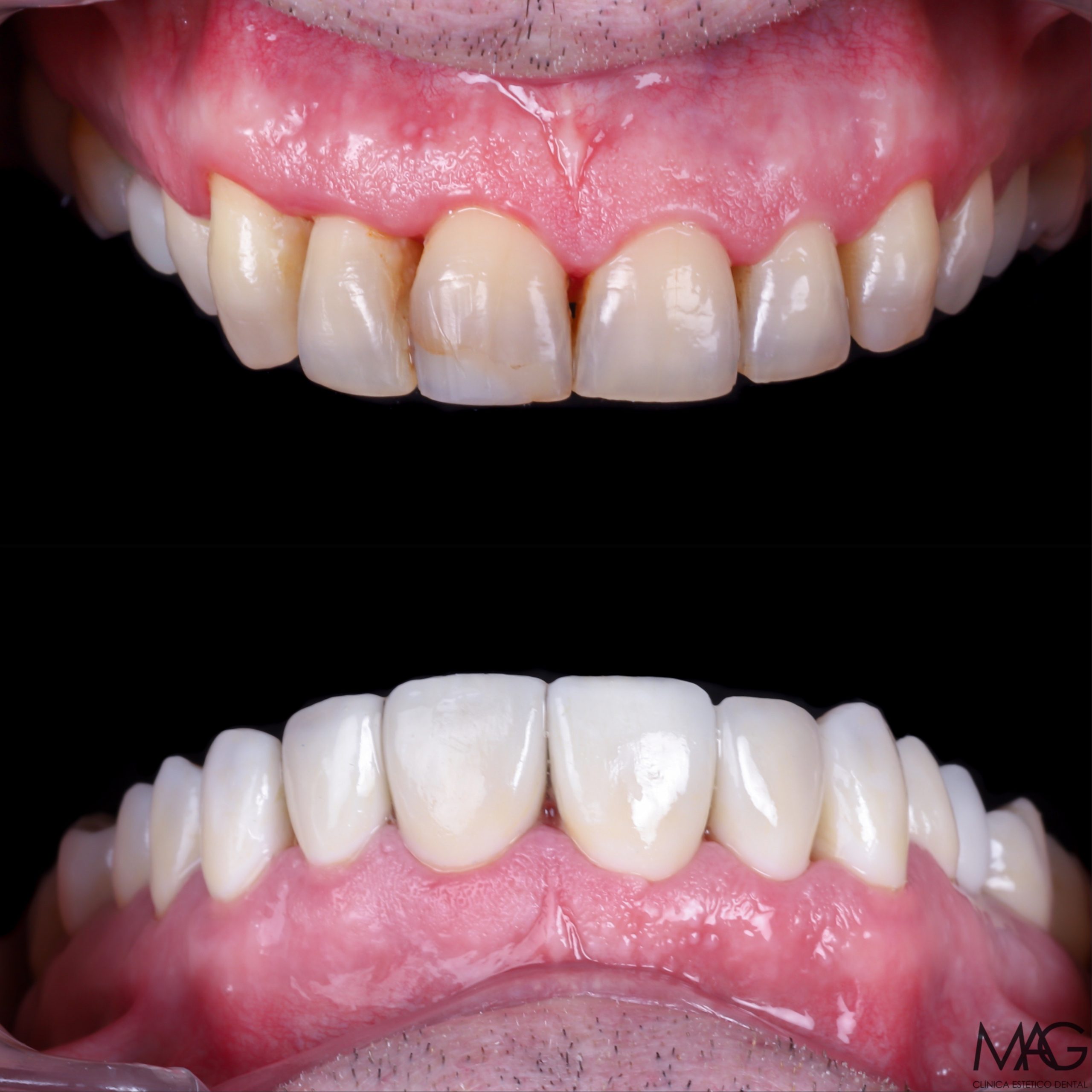 Carillas dentales en Madrid