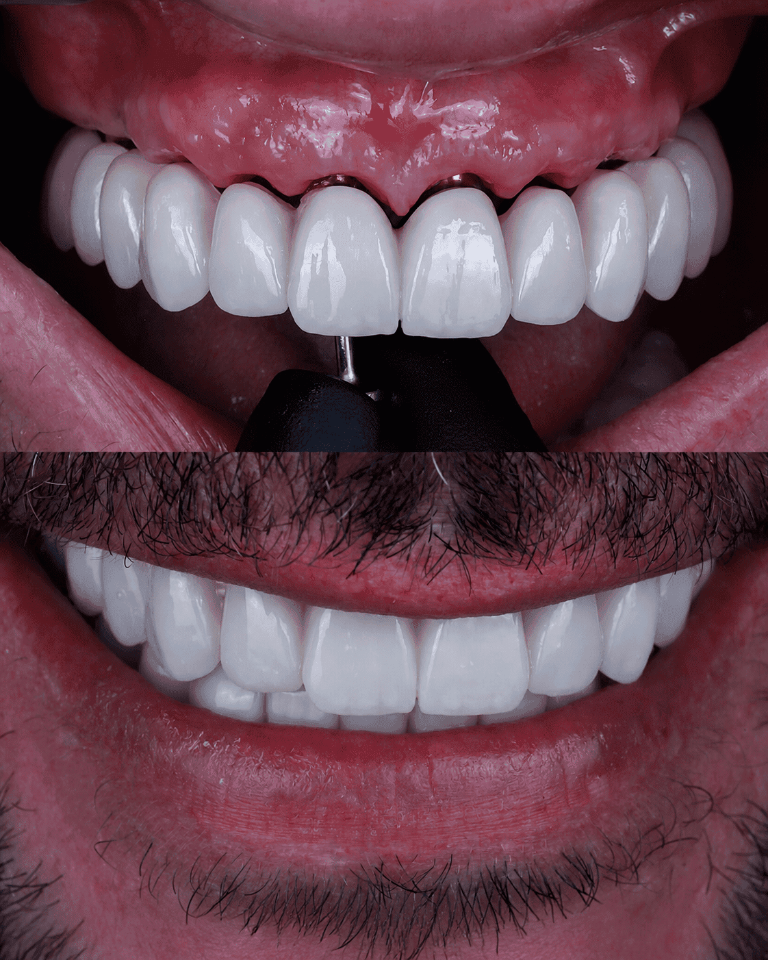 Antes y después de prótesis fija sobre implantes en la arcada superior