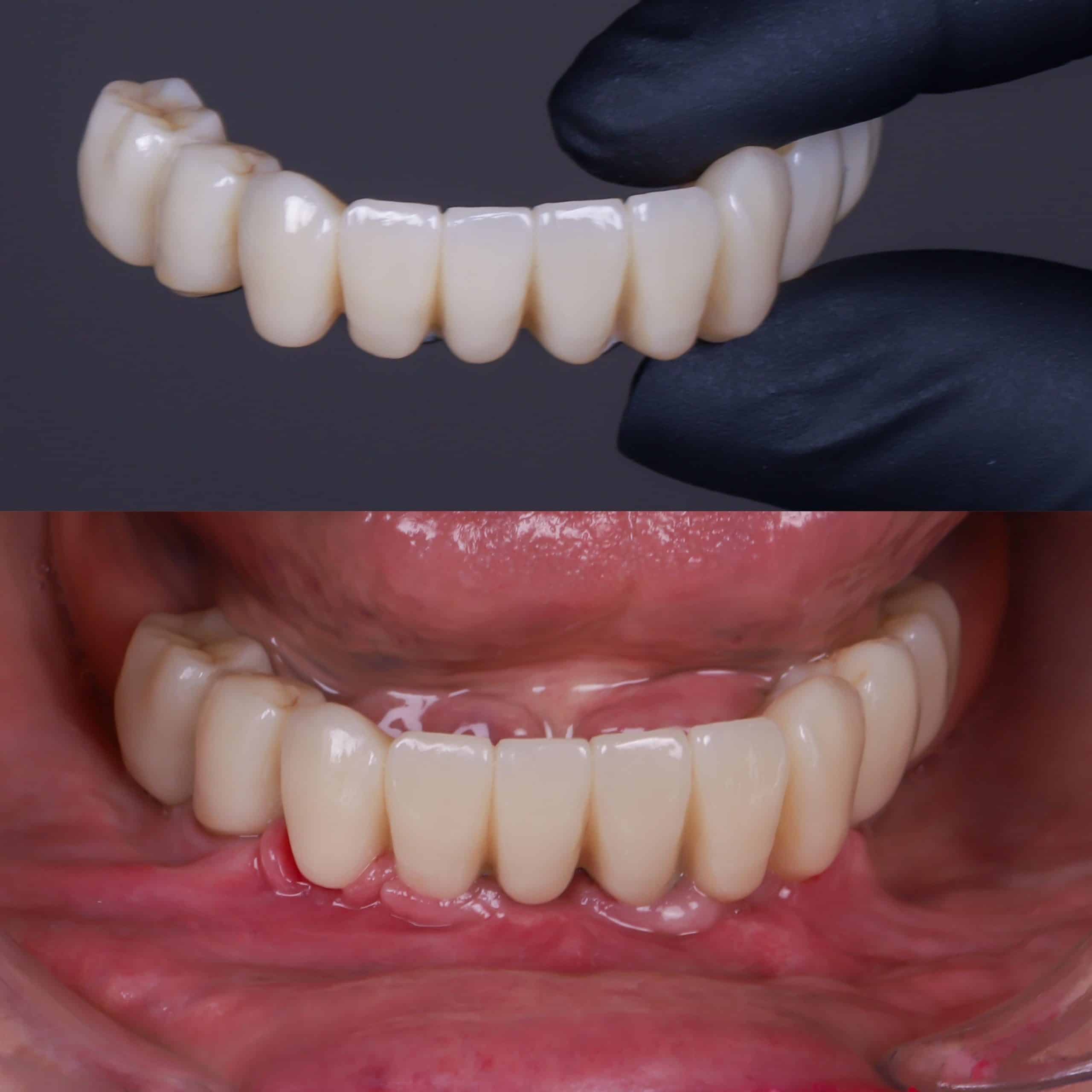 Prótesis fija sobre implantes de la arcada inferior antes y después de colocarla