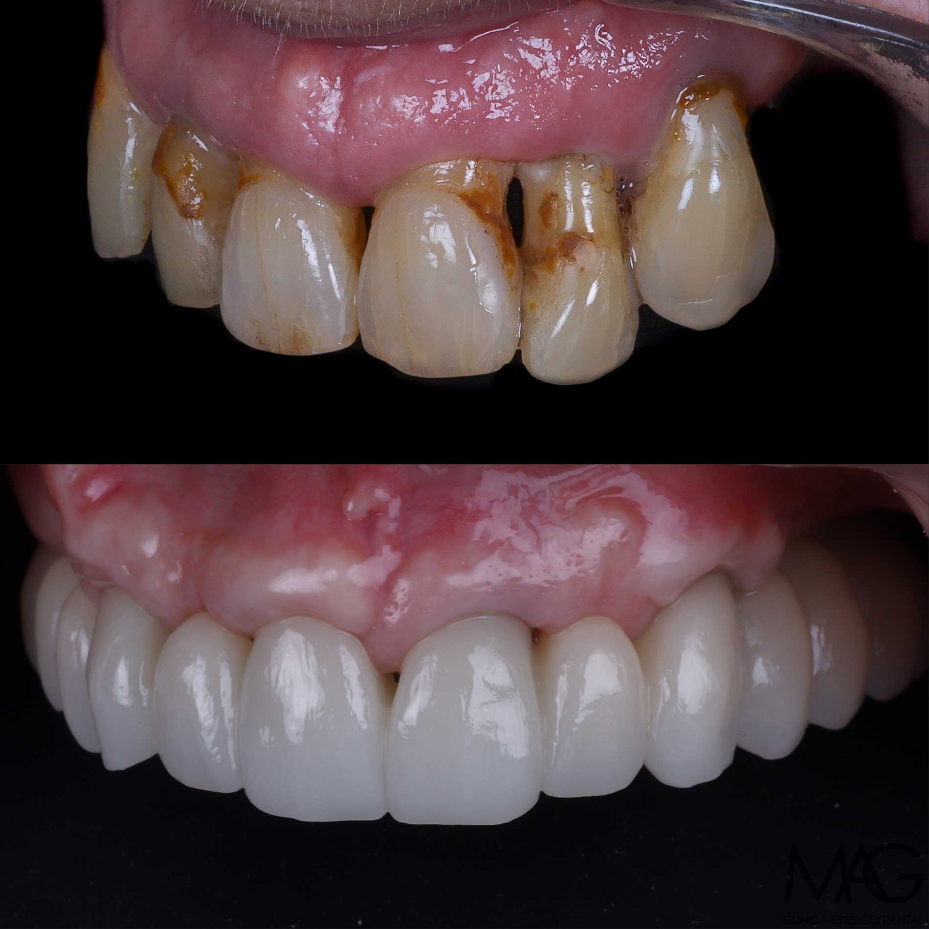 Antes y después de un paciente con enfermedad periodontal tratado con extracciones e implantes dentales