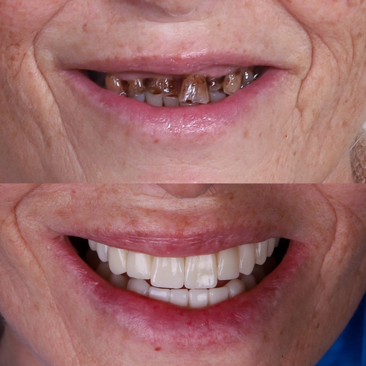Sonrisa antes y después de una rehabilitación con implantes dentales y prótesis fija