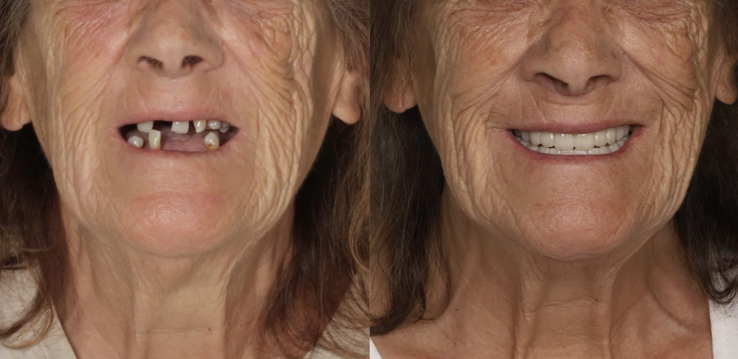 Paciente antes y después de implantes dentales de boca completa en MAG Dental Madrid