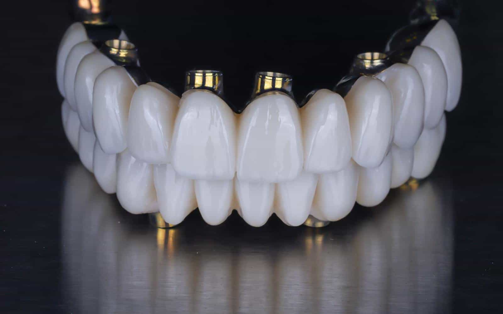 Implantes dentales boca completa en el día