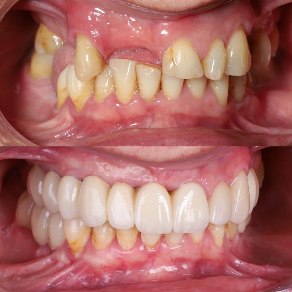 implantes de carga inmediata sin hueso