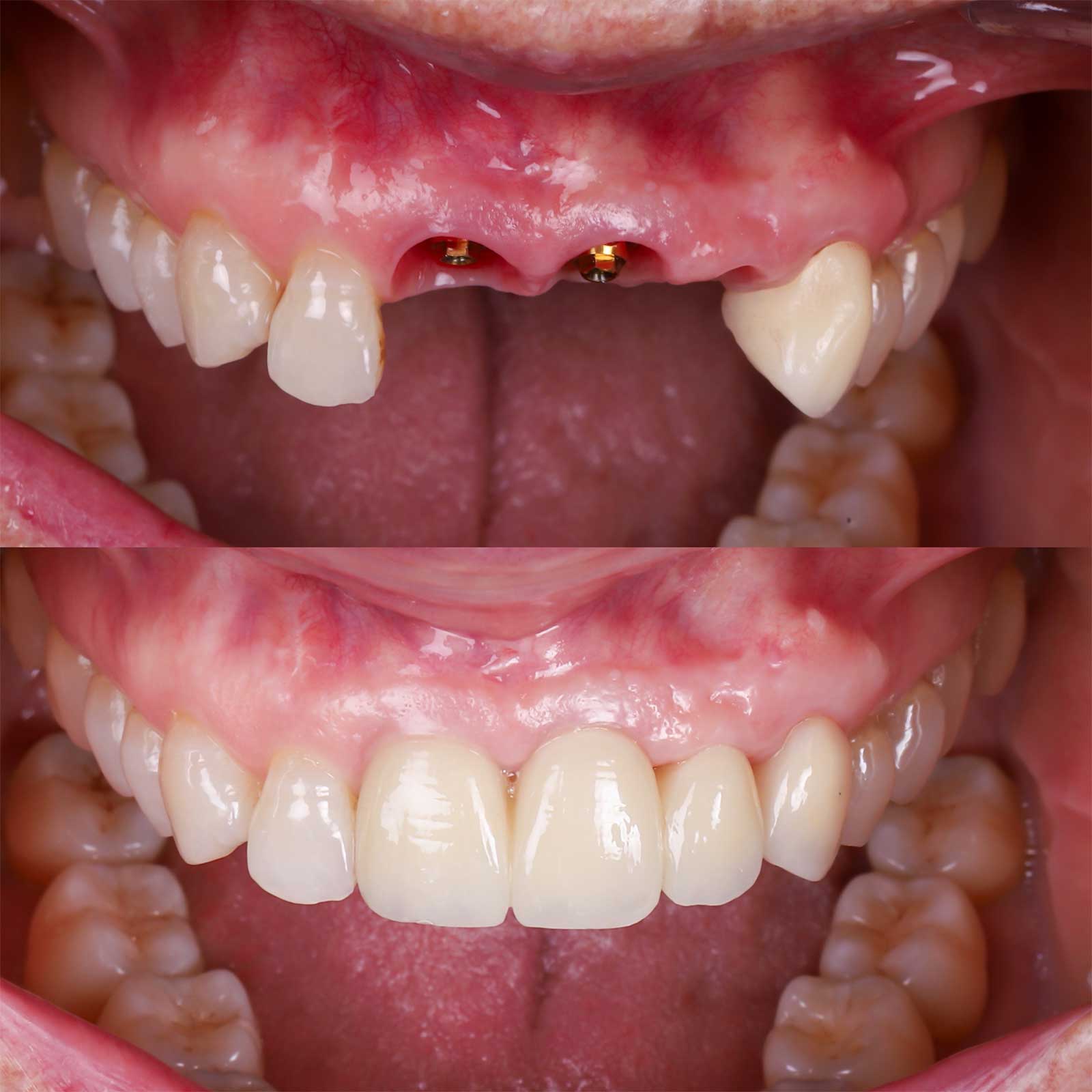 Caso de Restauración de múltiples dientes con implantes dentales